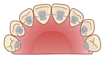 歯の裏側につける舌側矯正装置